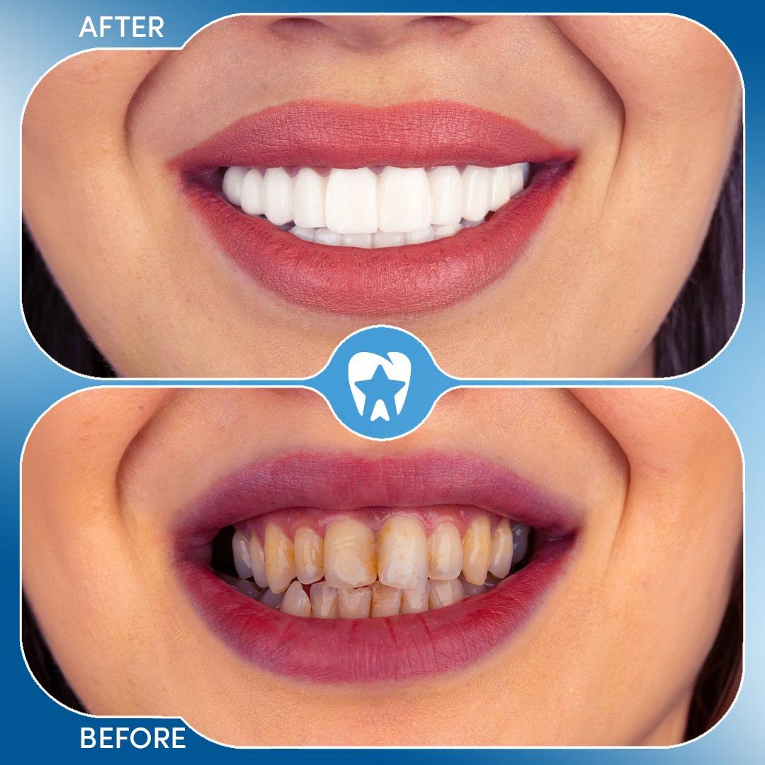 Before and after dental treatment